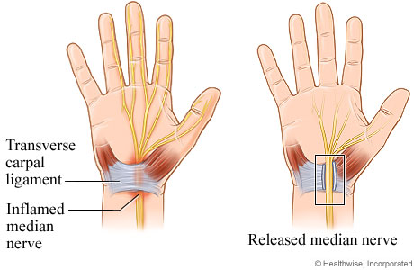 Carpal Tunnel Syndrome