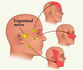 Trigeminal nevralji (yüz ağrısı)
